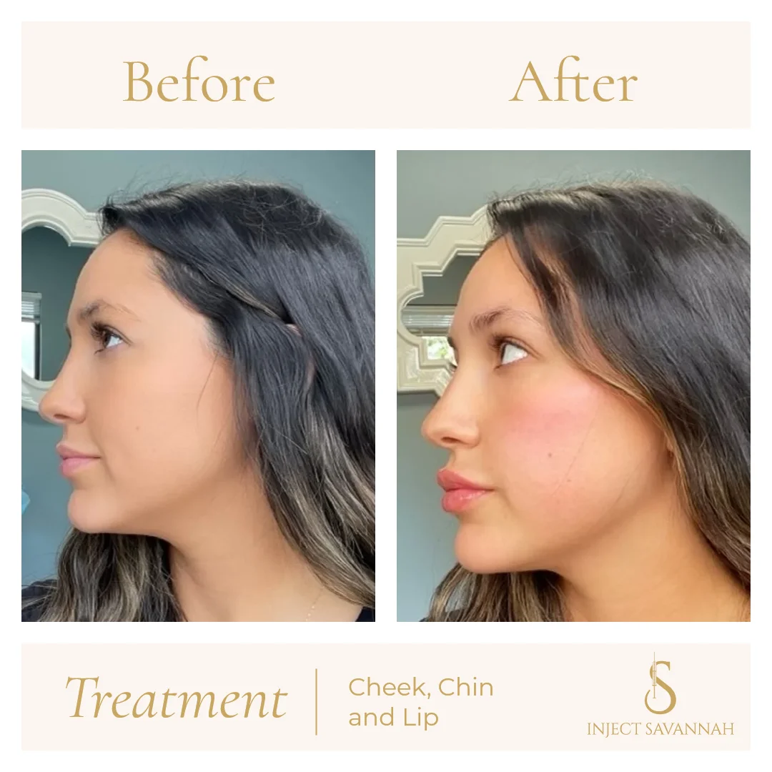 Aestheticsavannah Before and After Cheek Chin and Lip One In Savannah GA