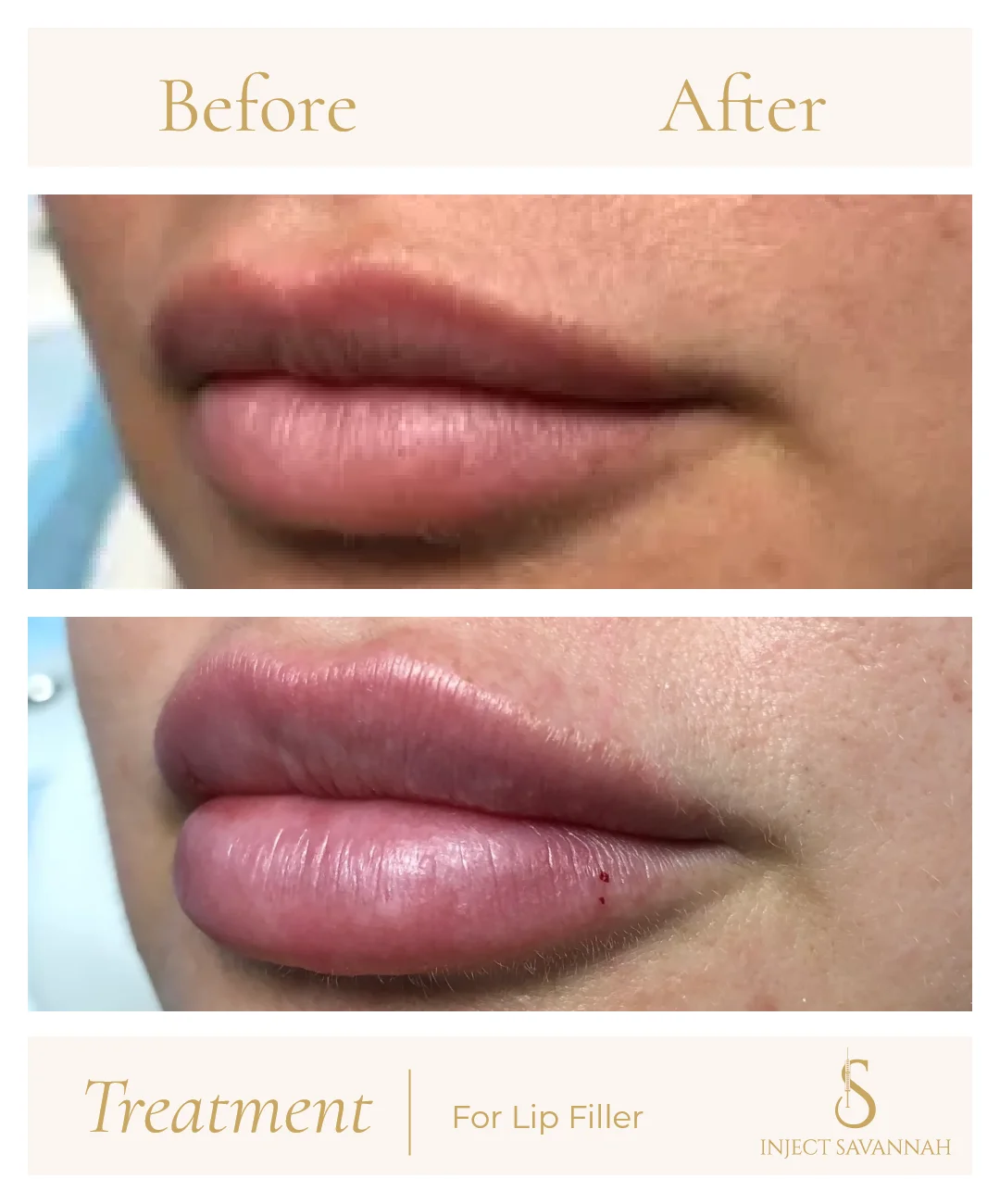 Aestheticsavannah Before and After Lip Filler One In Savannah GA