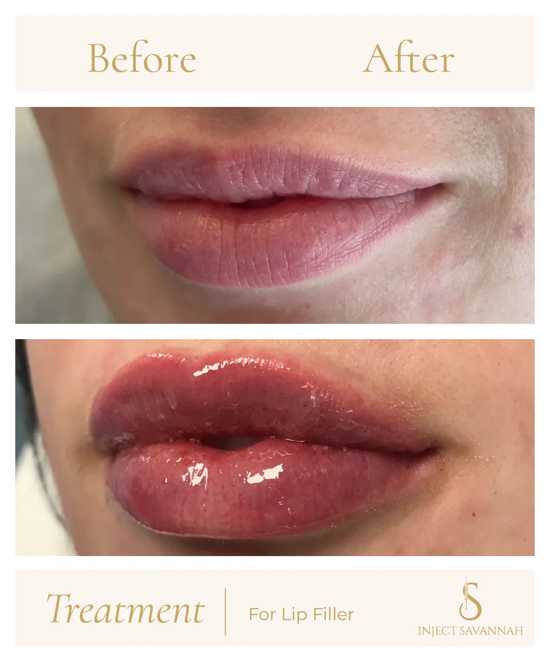 Aestheticsavannah Before and After Lip Filler Three In Savannah GA