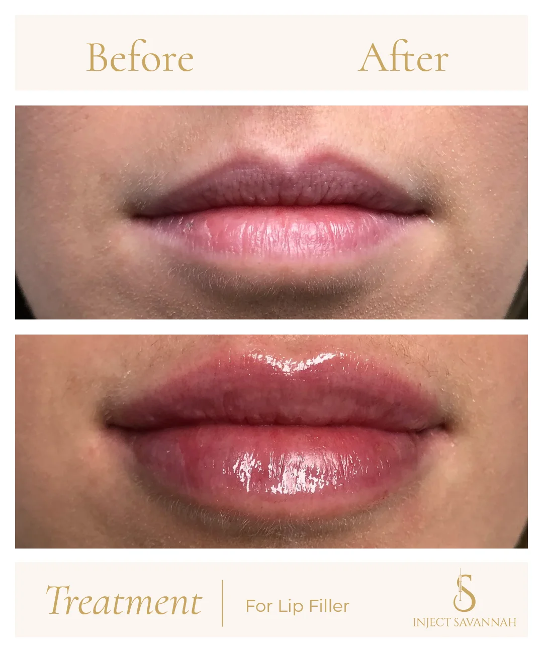 Aestheticsavannah Before and After Lip Filler Two In Savannah GA